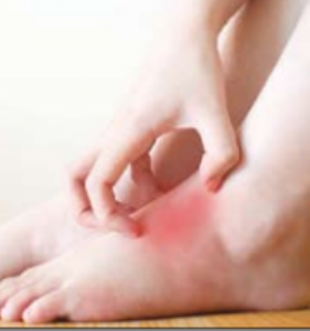 पायांची आगआग व जळजळ हाेणे यावरील उपाय